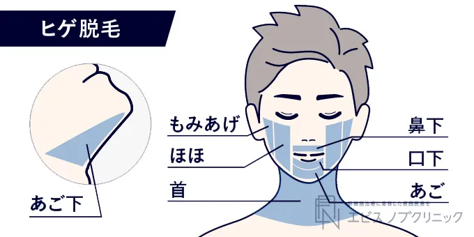 ヒゲ脱毛の施術に含まれる範囲