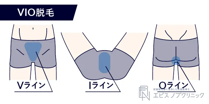 メンズのVIO脱毛に含まれる範囲