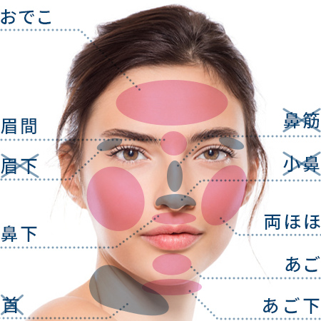 TCB東京中央美容外科の顔脱毛の施術範囲
